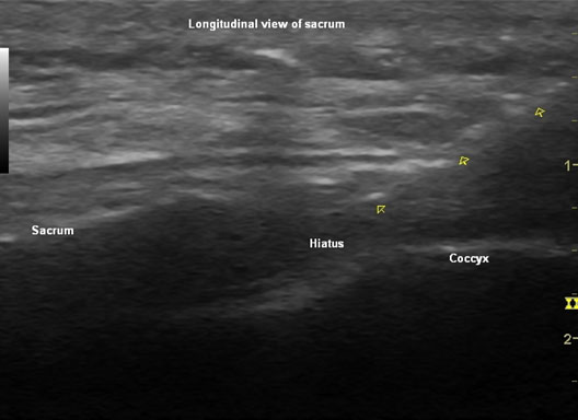 Caudal injection longitudinal sonographic view