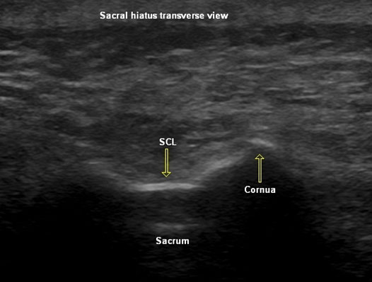 Caudal Injection Sonographic View