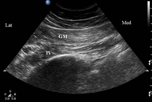 pudendal-nerve-injection-sonogram-showing-the-underlying-muscle-layers