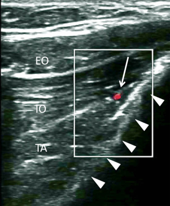 ultrasound-guided-block-for-peripheral-structures-deep-circumflex-iliac-artery