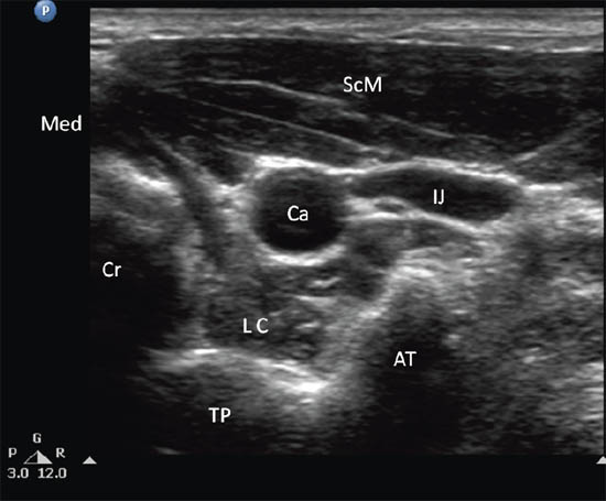 ultrasound-guided-block-for-peripheral-structures-ultrasonographic-image-of-neck-