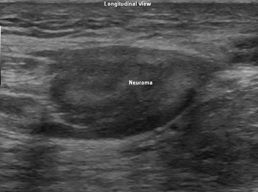 ultrasound-guided-neuroma-injection-transverse-longitudinal-view