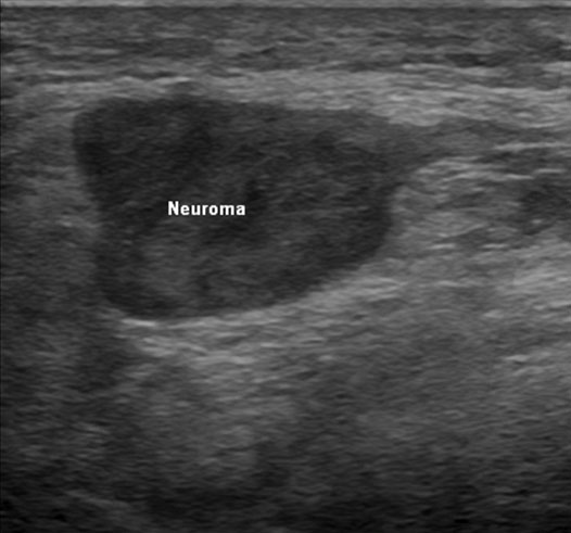 ultrasound-guided-neuroma-injection-transverse-sonographic-view