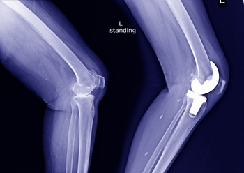 X-Ray of Knee