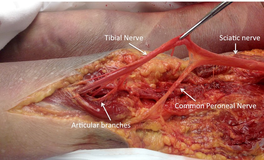  Dissection of Popliteal Fossa Showing Articular Branches to Posterior Knee Arising From Tibial Nerve