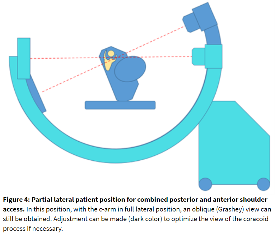 Figure 4: Partial lateral patient position